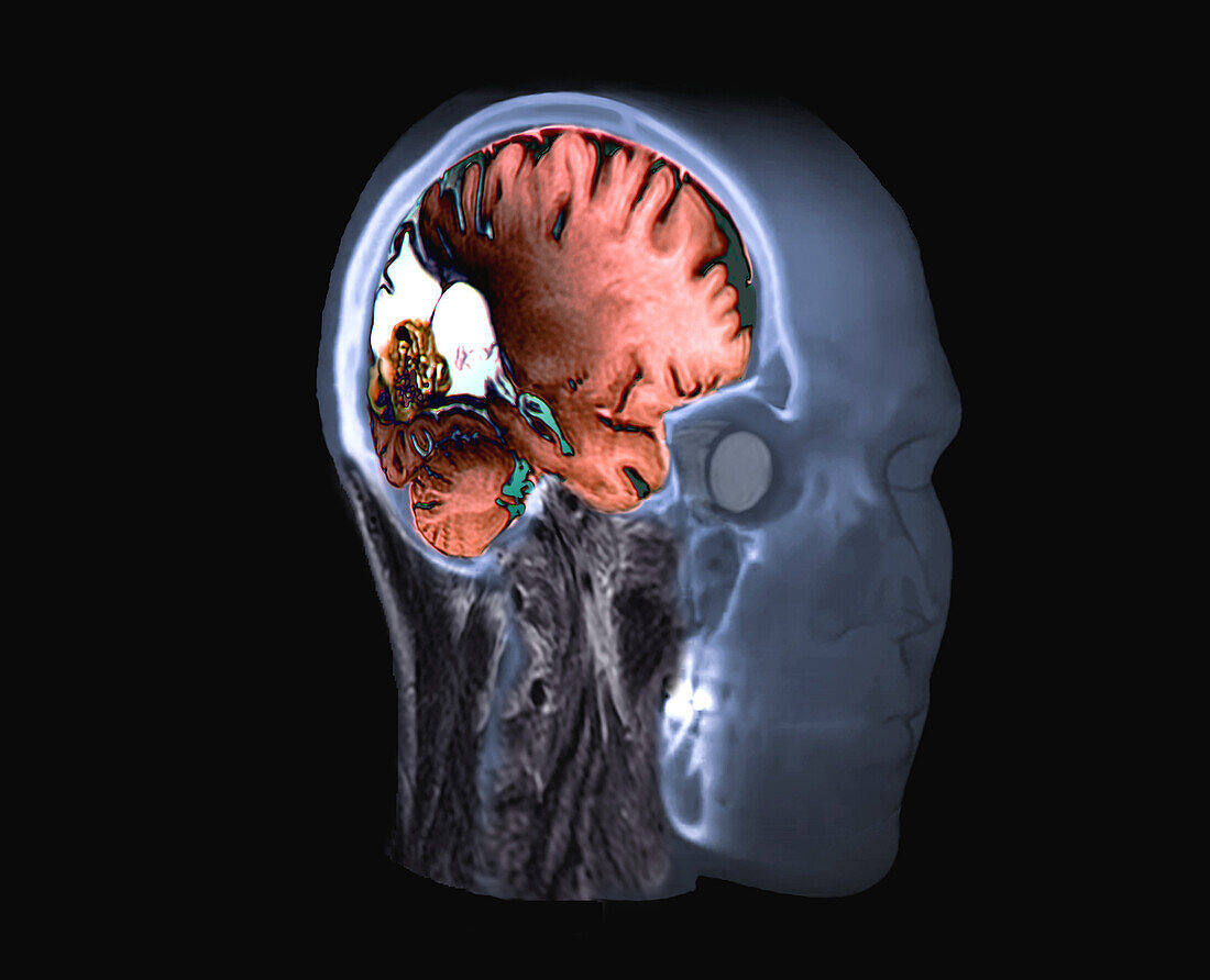 Arteriovenous Malformation Composite Acheter Une Photo 13599669