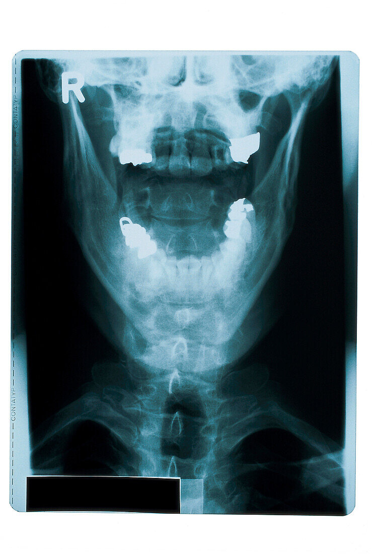 Röntgenbild eines Kopfes