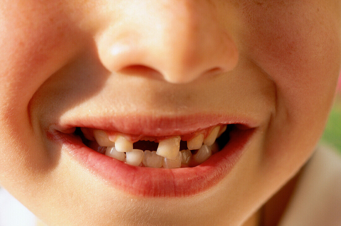 Boy missing tooth
