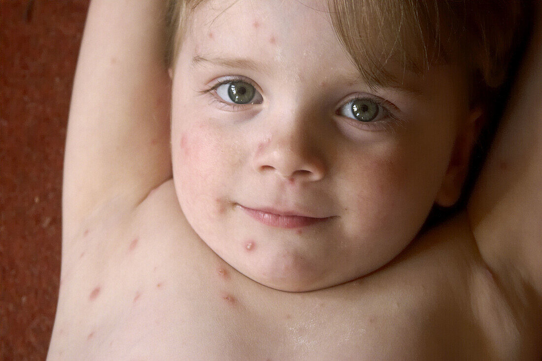 3 year old girl smiling into camera covered in chickenpox