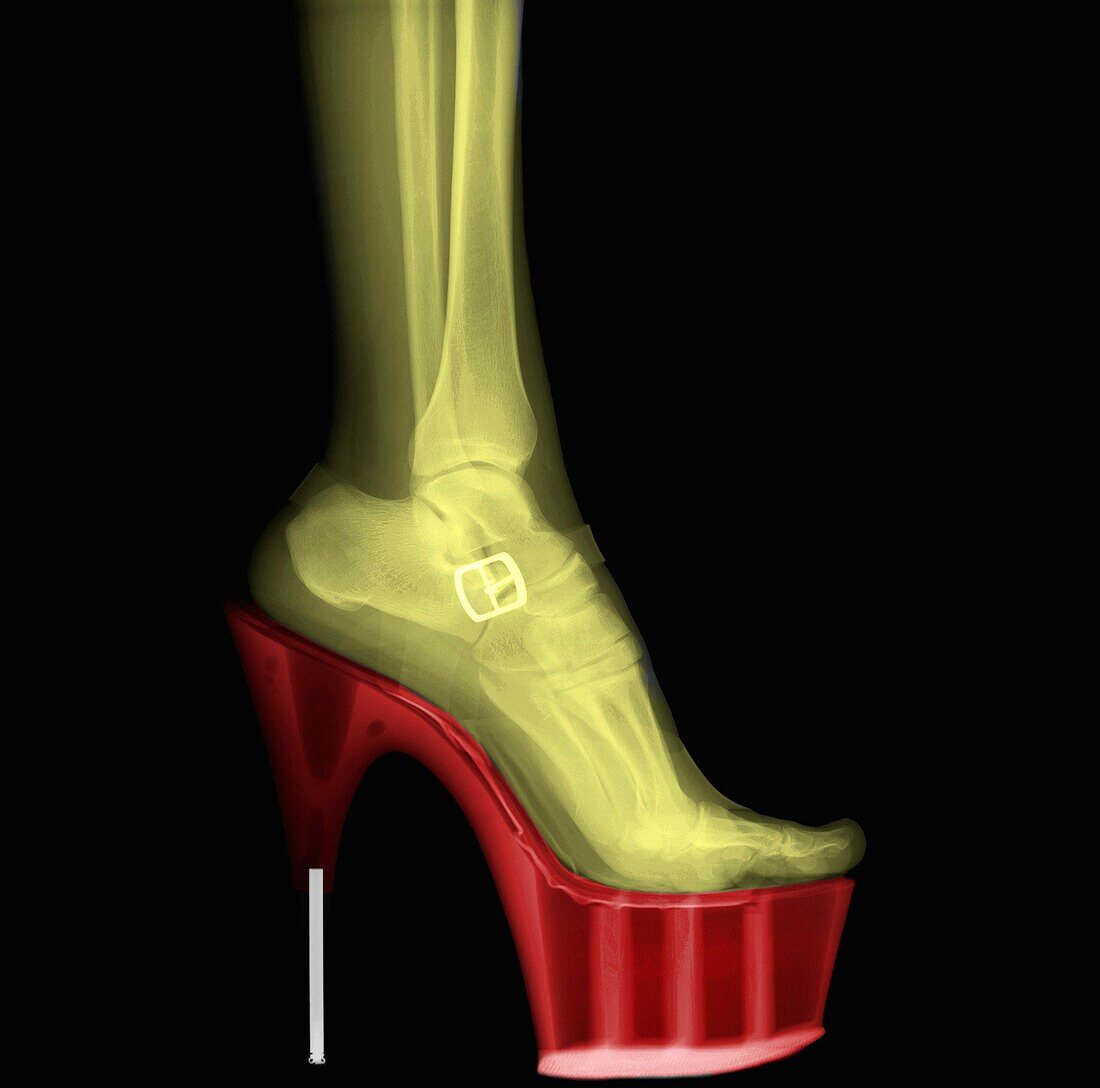 Coloured X-ray of a woman leg wearing Stiletto High-Heeled Shoe