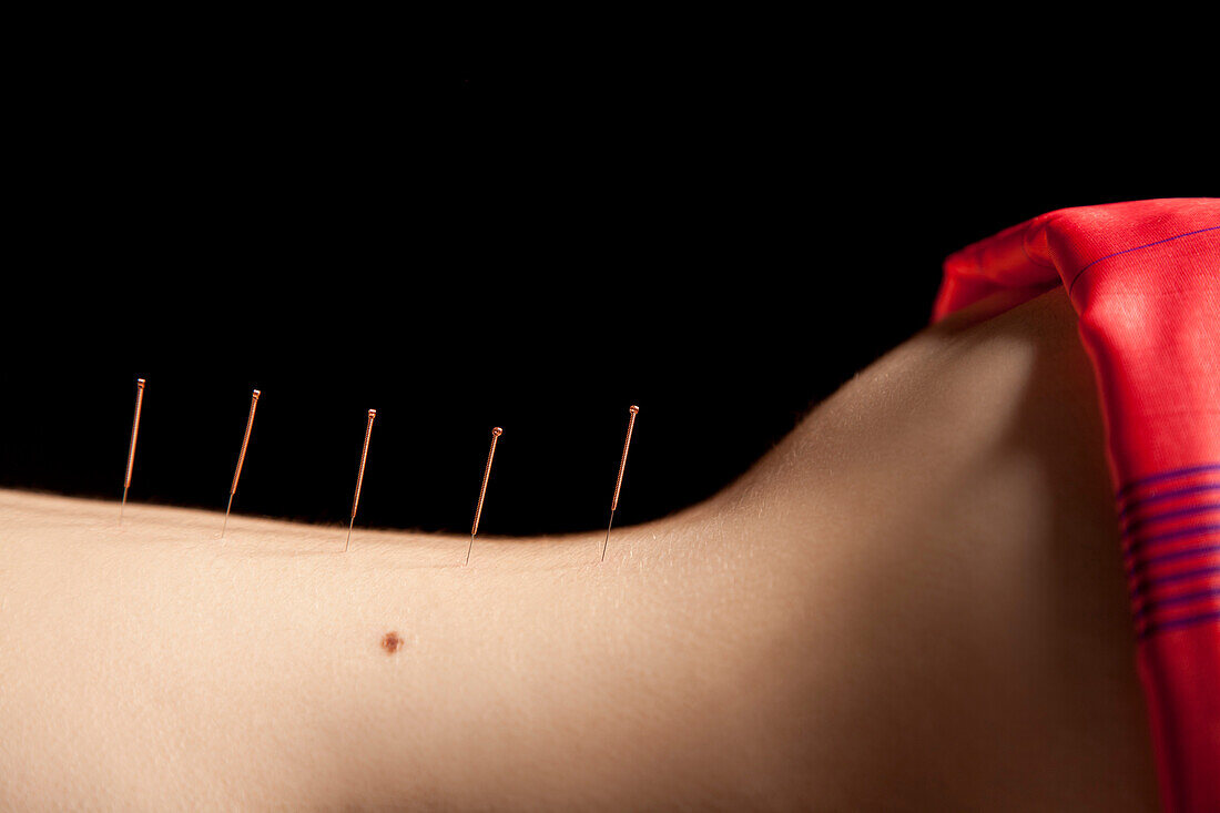 woman back acupuncture