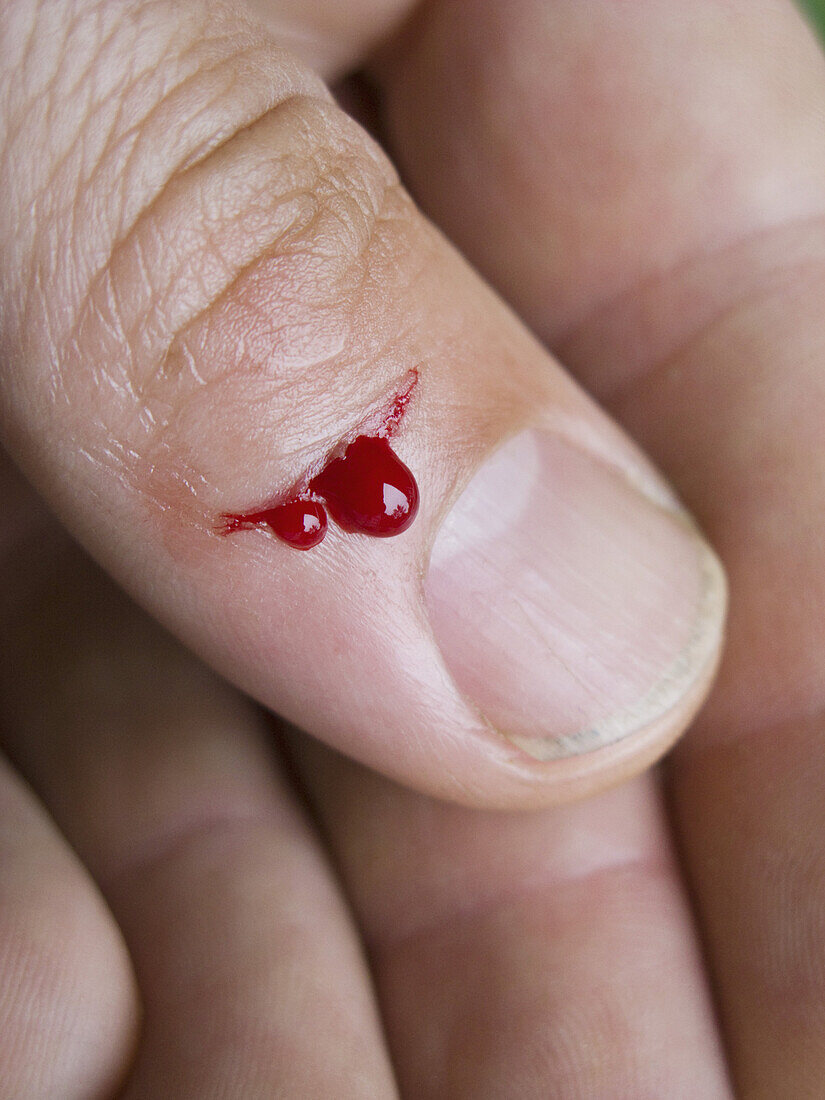 Blood seeping from a thumb