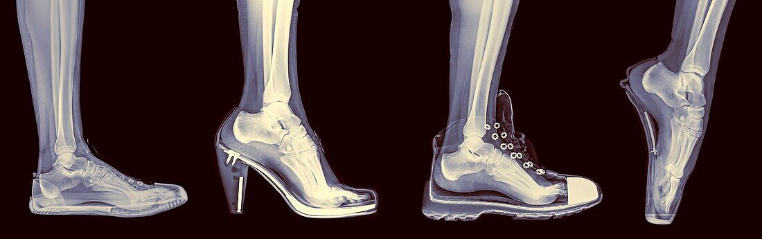 X-ray of a woman´s foot in 4 different shoes (from left to right) Trainers, High Heel, Running and Ballet.