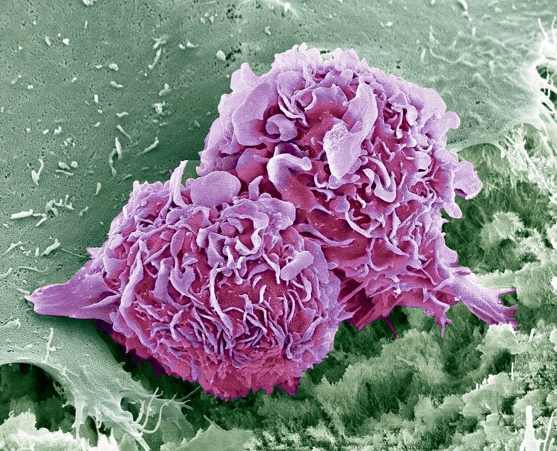 Bone cancer cells,SEM