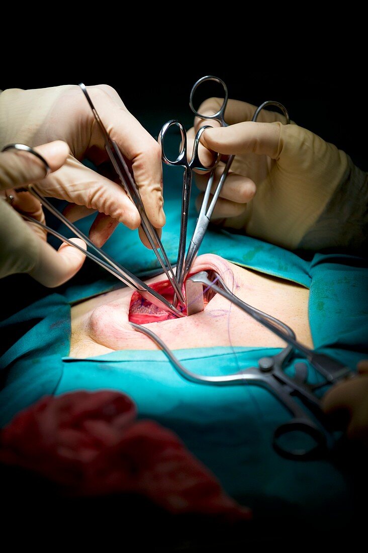 Hernia operation