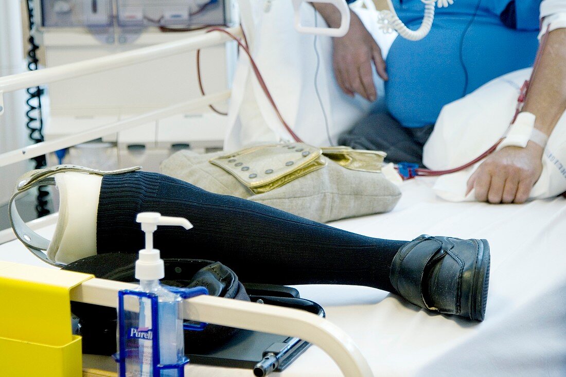 Prosthetic leg of kidney dialysis patient