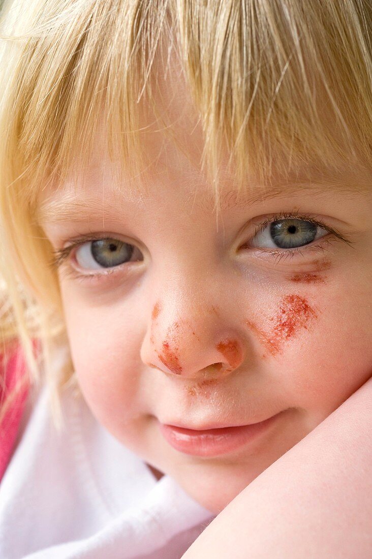 Girl with a grazed face