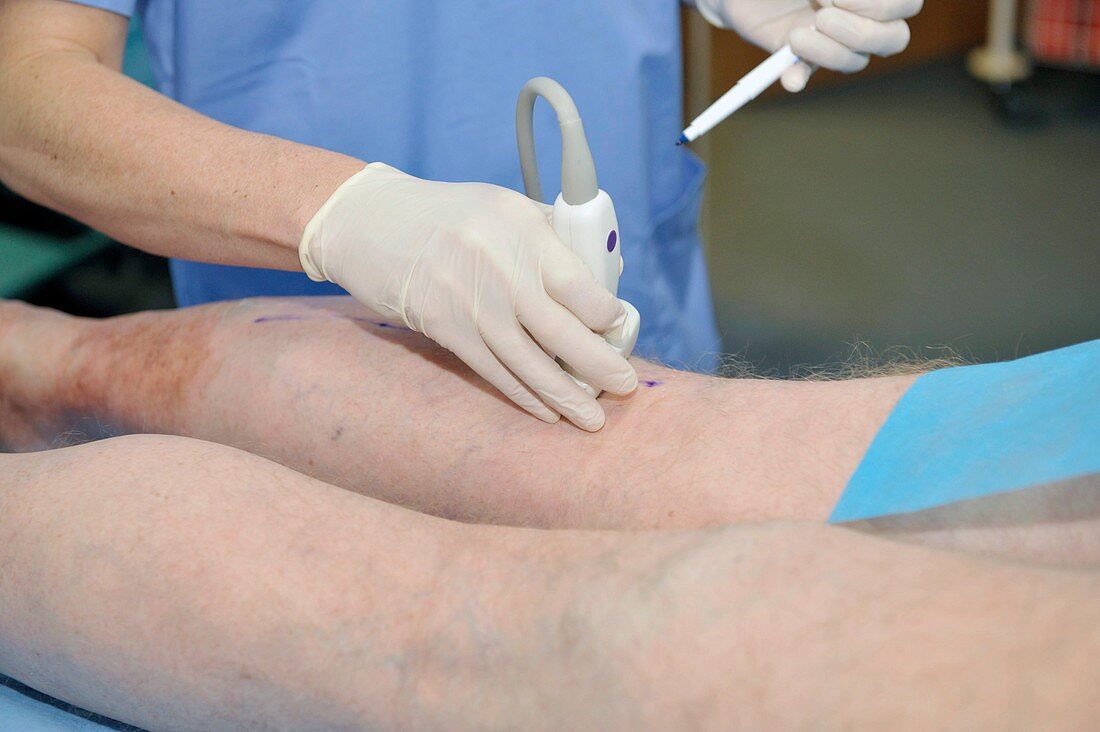 Ultrasound assessment of varicose veins
