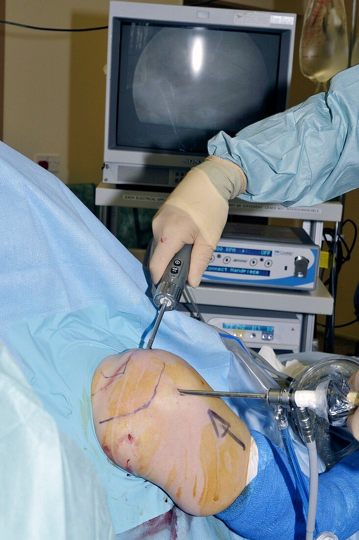 Shoulder arthroscopy procedure