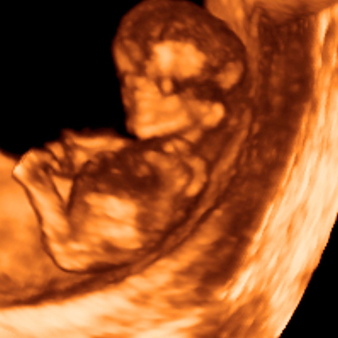 Foetus at 11 weeks,3D ultrasound