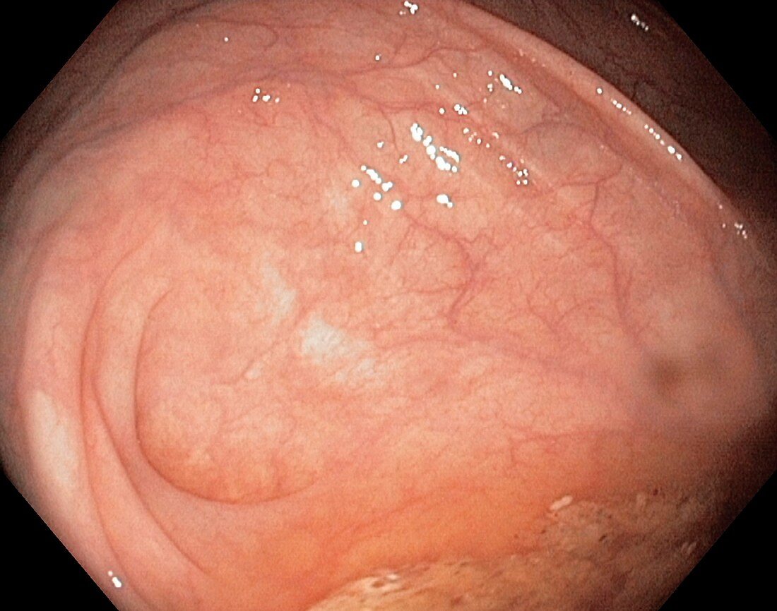 Healthy caecum,large intestine