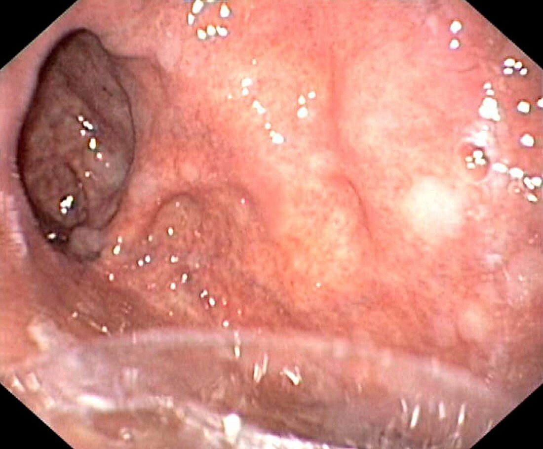 Diverticulum of the stomach