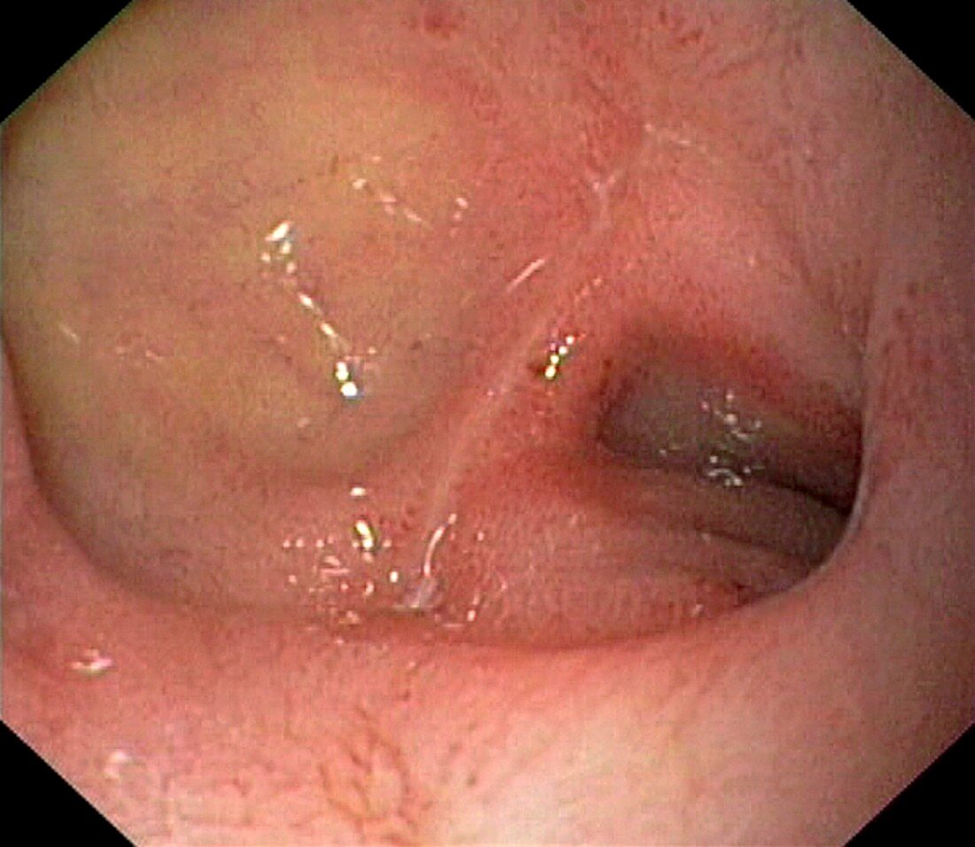 Scarred duodenal bulb