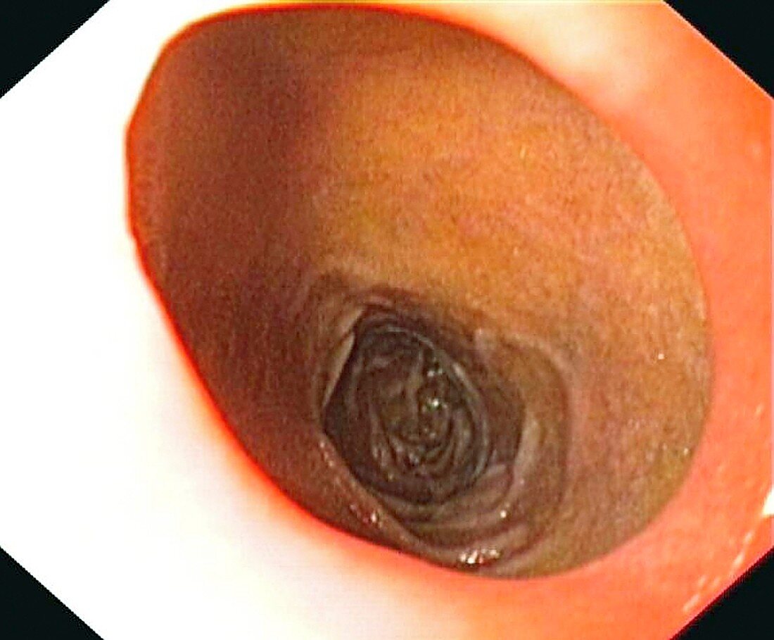 Healthy duodenal bulb and pylorus