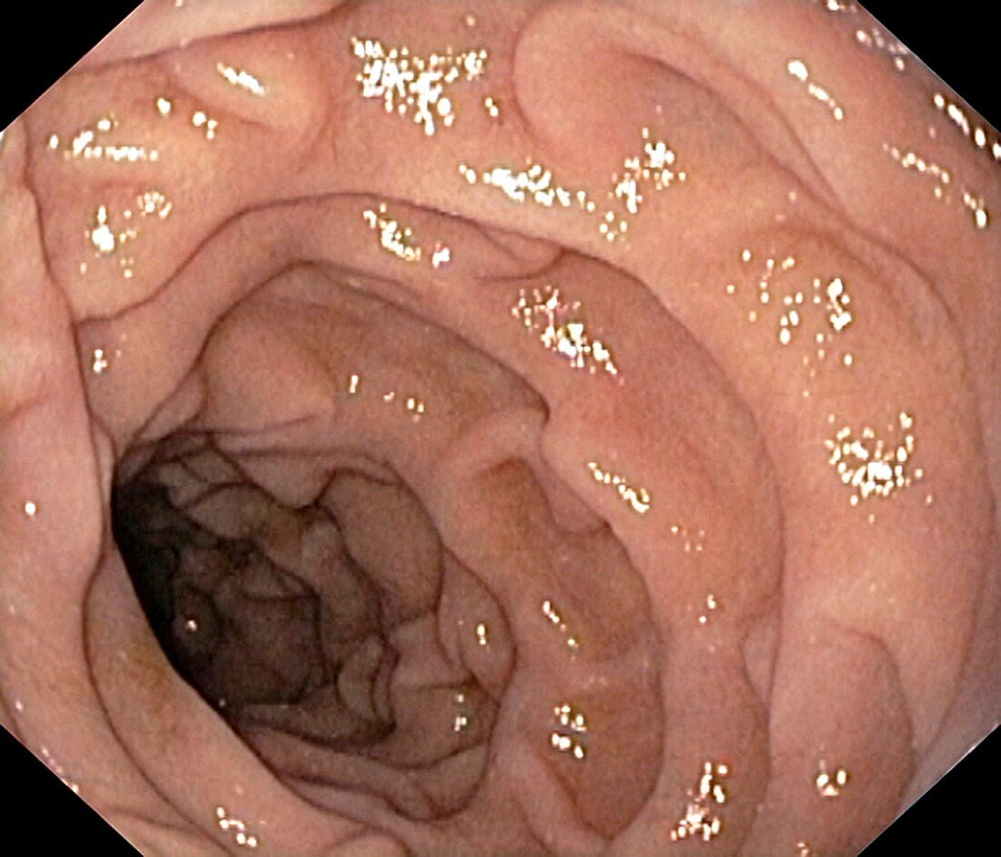 Healthy duodenum,small intestine