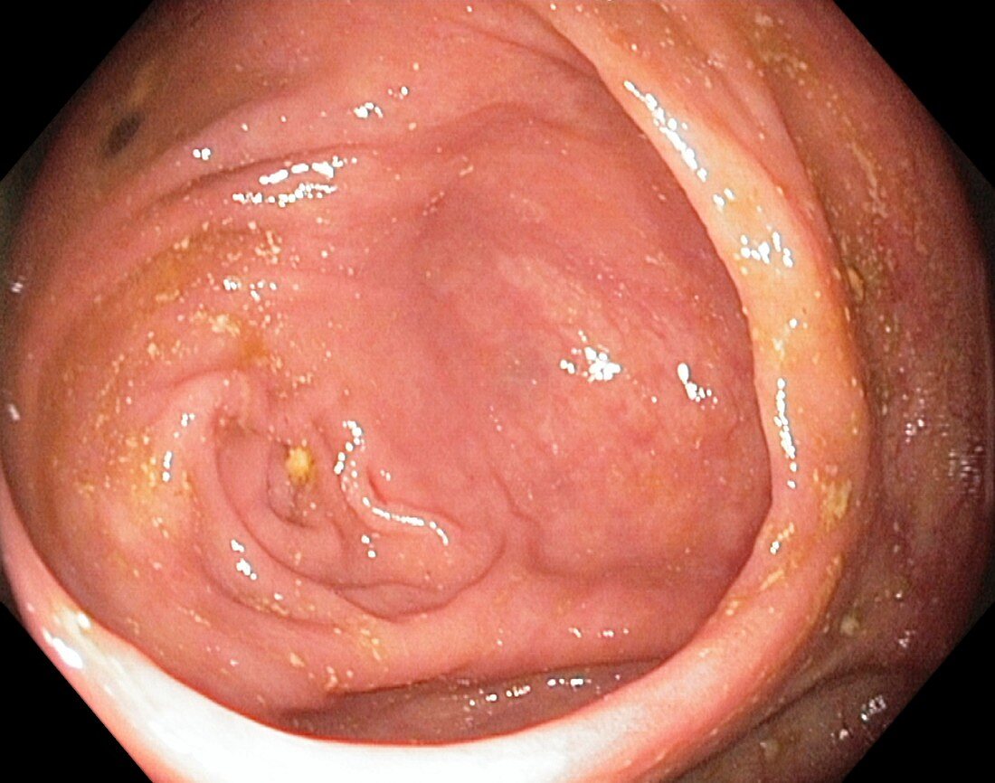 Healthy caecum,large intestine