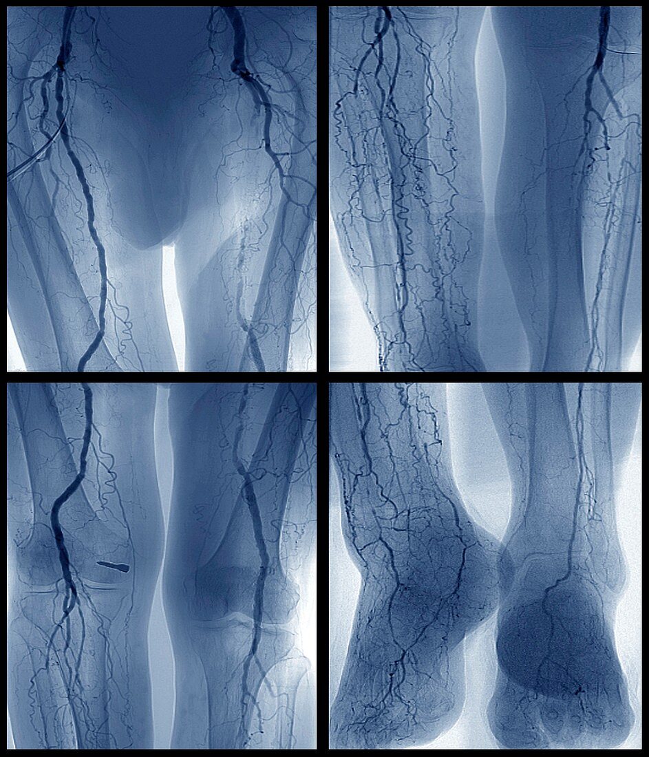 Arteritis,angiogram