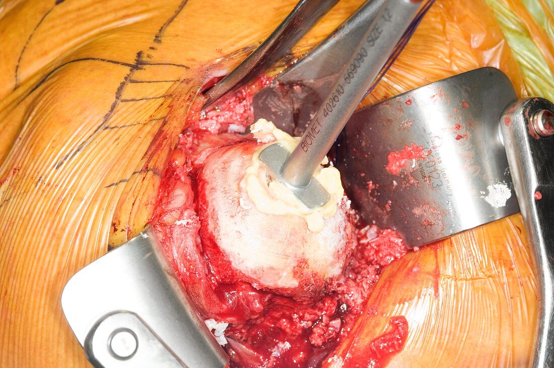 Shoulder joint re-surfacing surgery