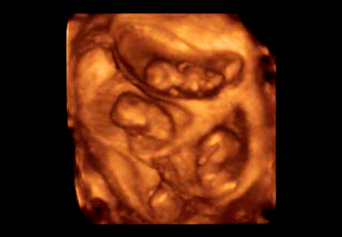 Quadruplets,4-D ultrasound scan