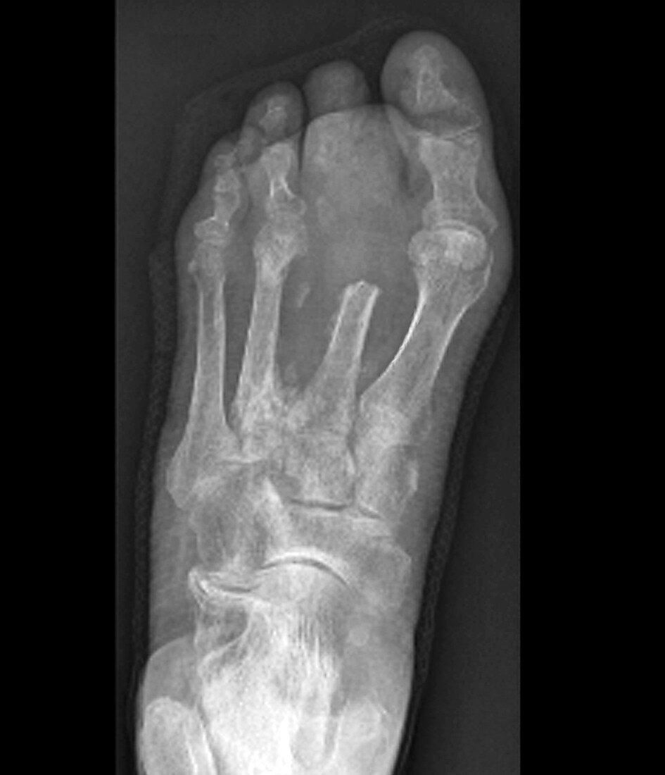 Bone infection,X-ray