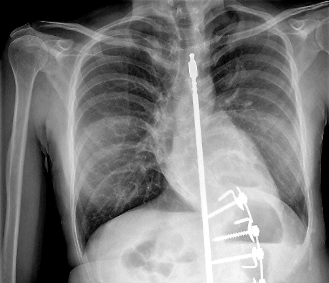 Treatment for scoliosis,X-ray