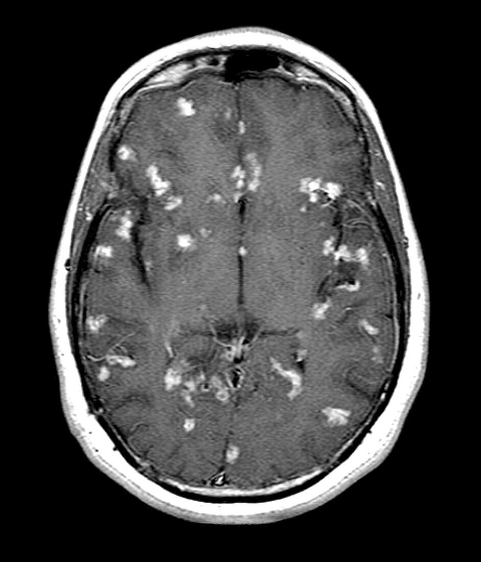 Diseased brain,MRI scan