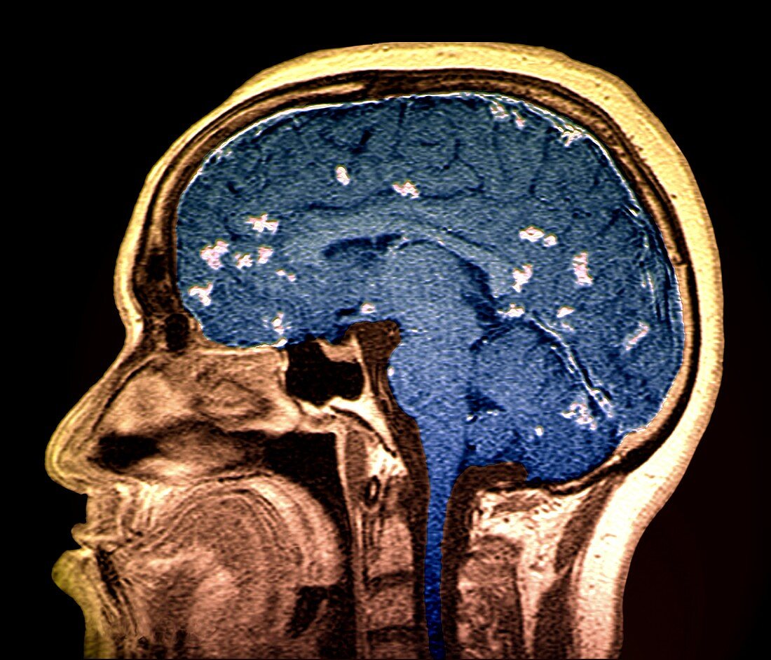 Diseased brain,MRI scan