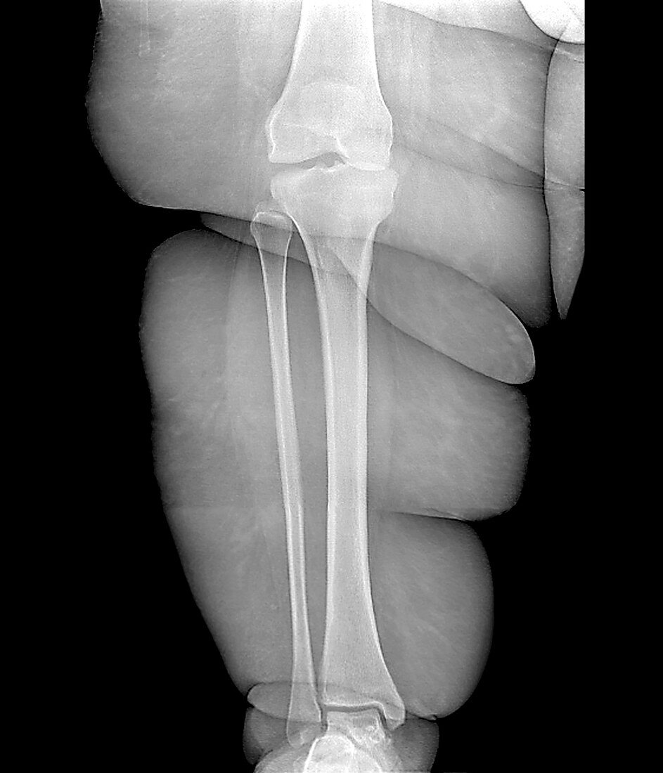 Obese person's leg,X-ray