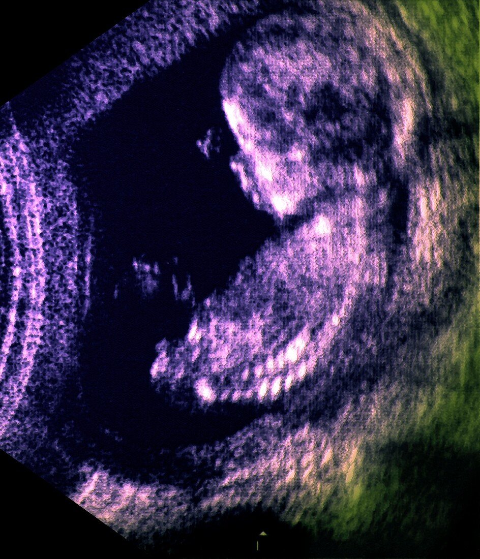 Foetus at 13 weeks,ultrasound