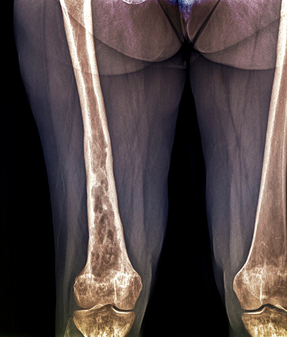 Bone disease,X-ray