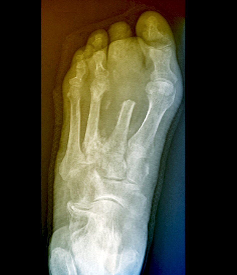 Bone infection,X-ray