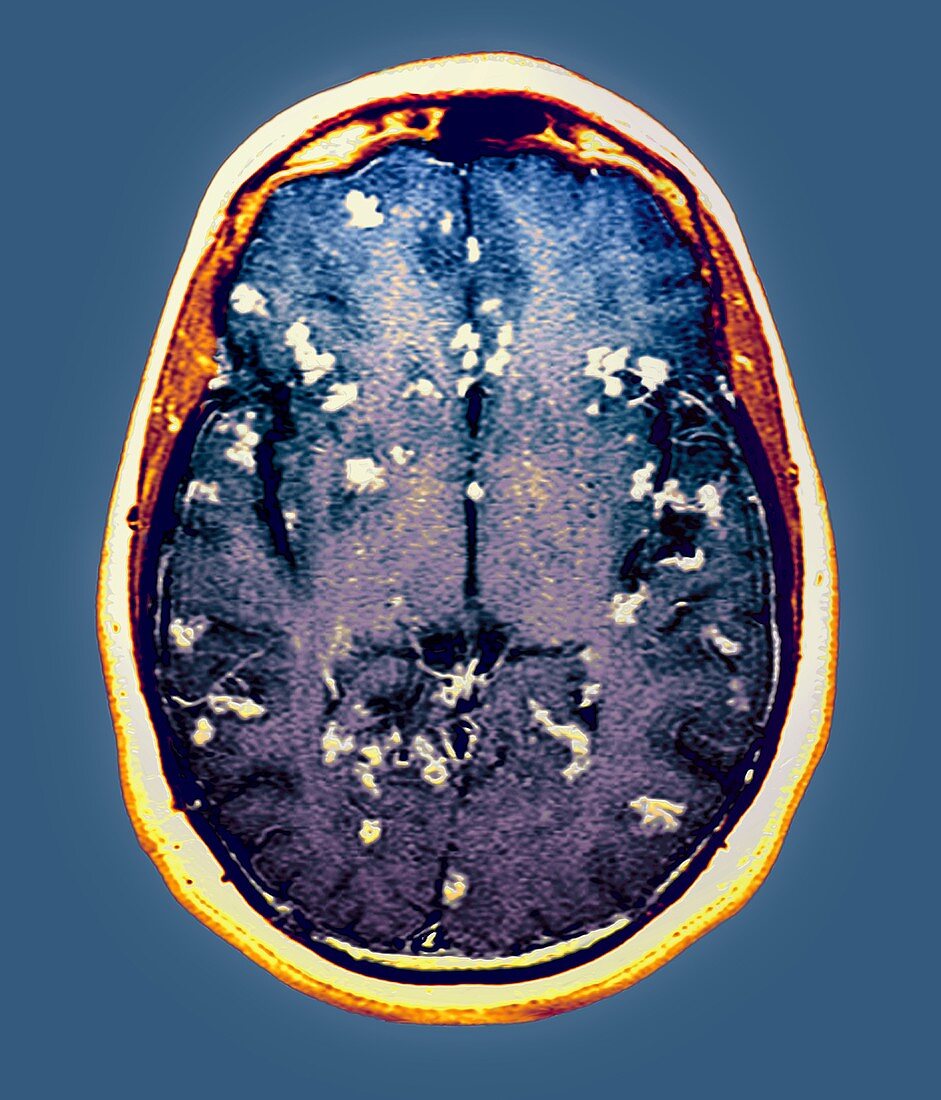 Diseased brain,MRI scan