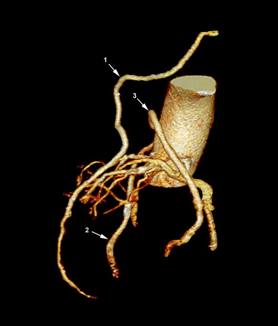 Heart bypass,3D CT scan