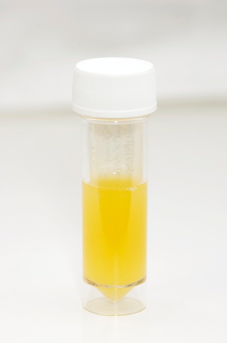 Fluid extracted from a knee effusion