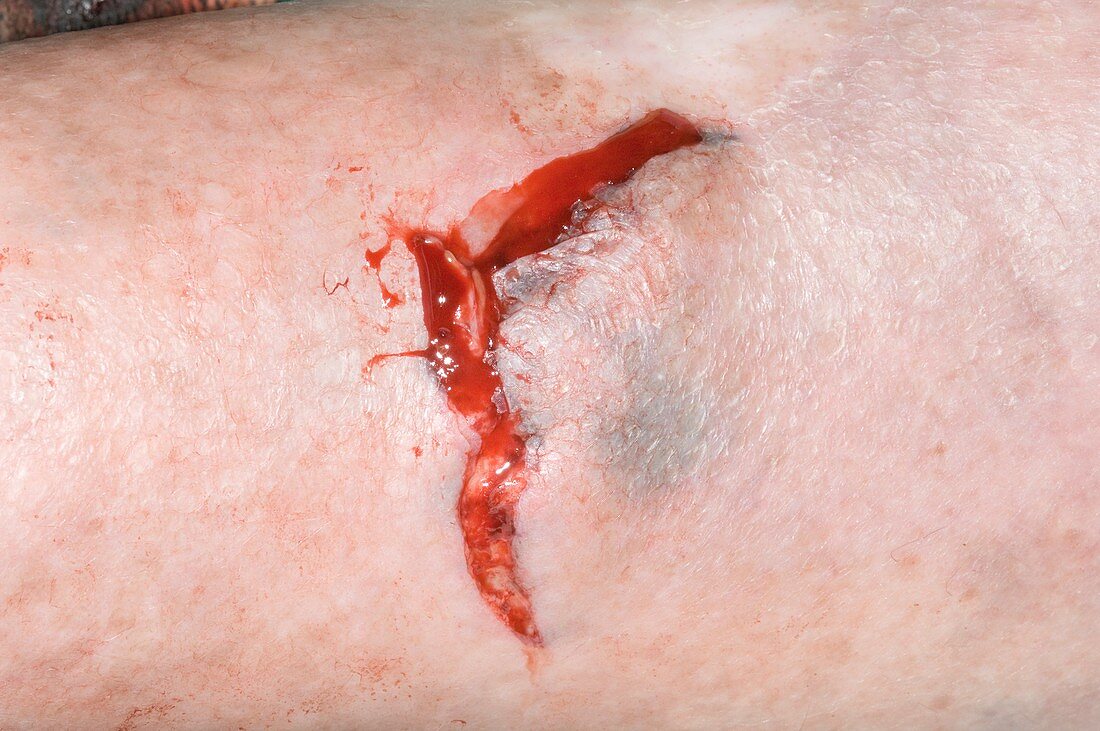 Shin wound