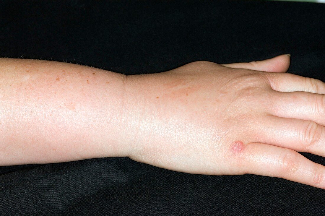 Insect bite allergy