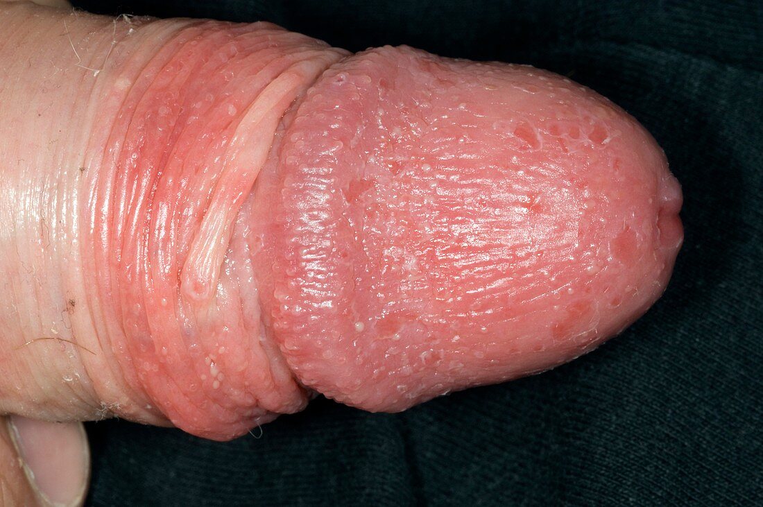 Genital thrush infection