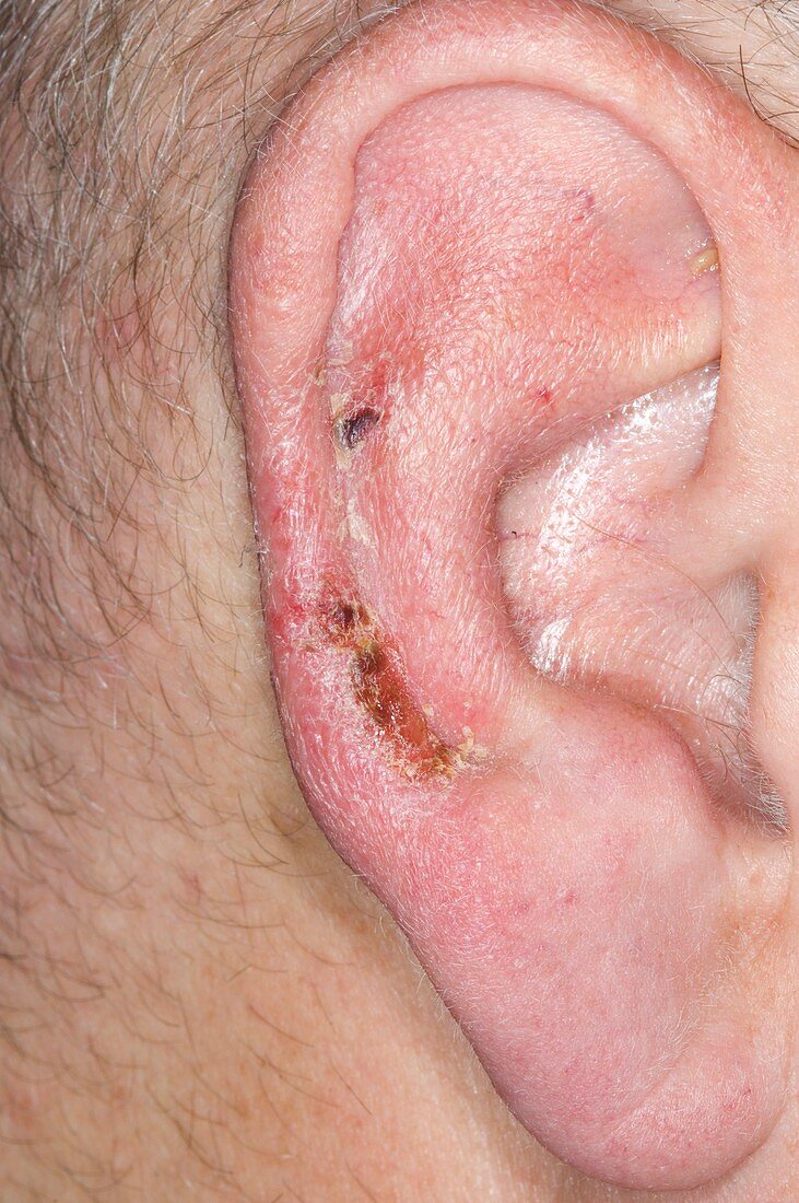 Herpes simplex lesion