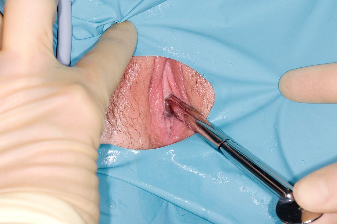 Urethral dilation surgery