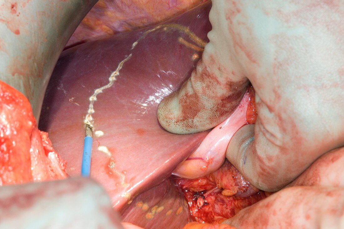 Gall bladder cancer surgery