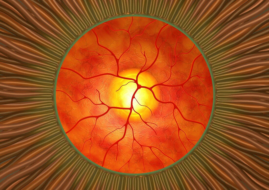 Retina in glaucoma,artwork