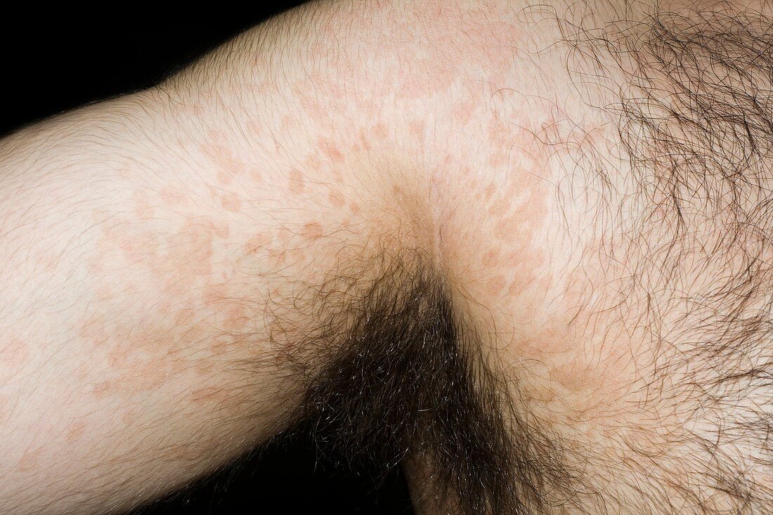 Tinea versicolor skin infection