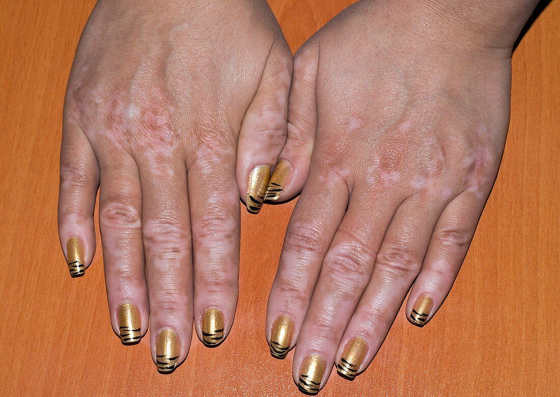 Vitiligo of the hands