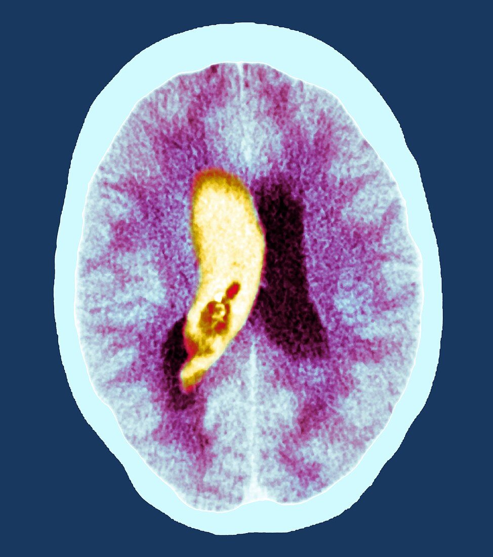 Brain haemorrhage,CT scan