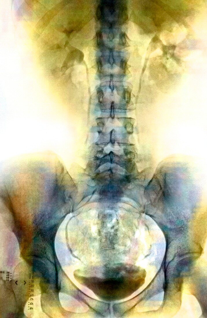 Spine and pelvis,X-ray