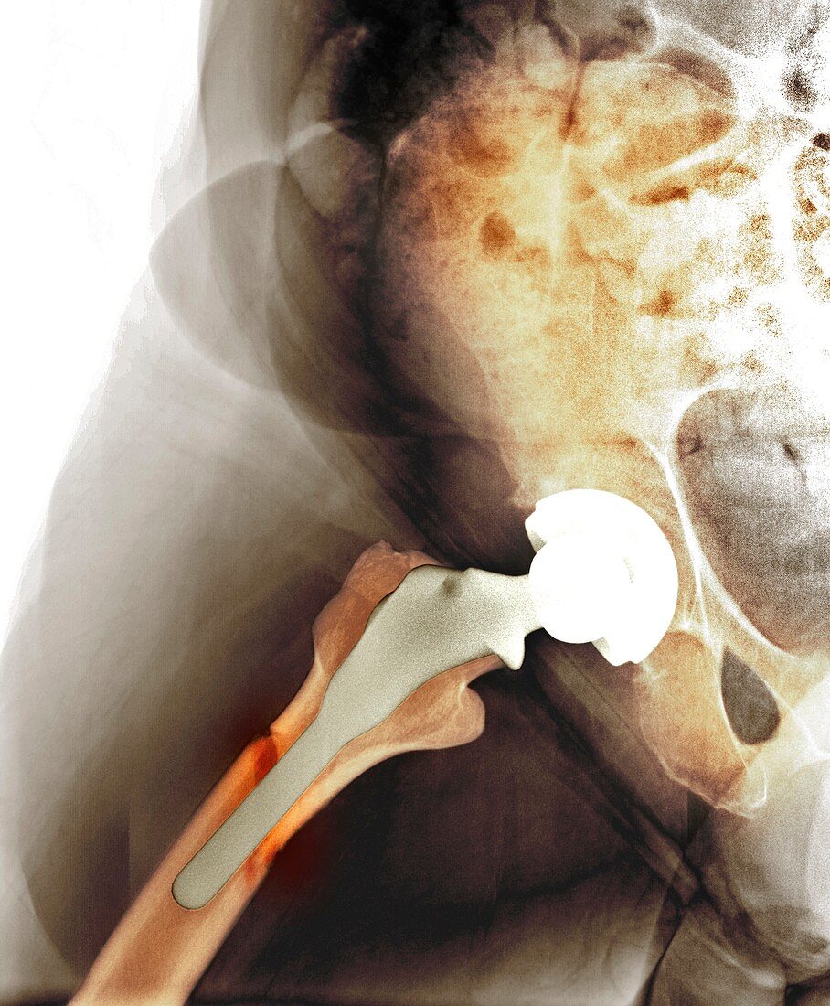 Failed hip resurfacing,X-ray