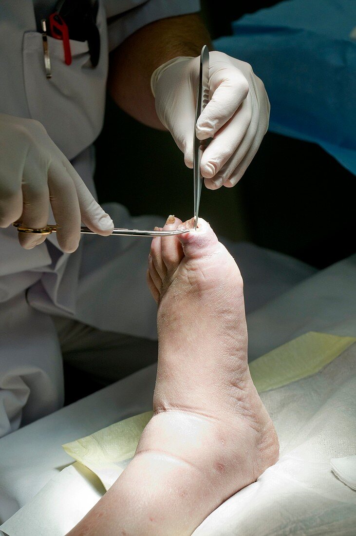 Amputation wound care
