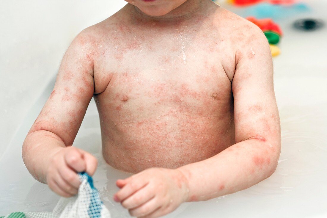 Young boy with eczema