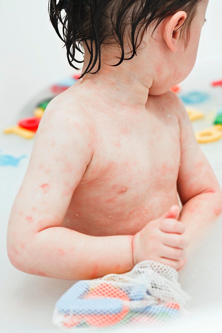 Young boy with eczema